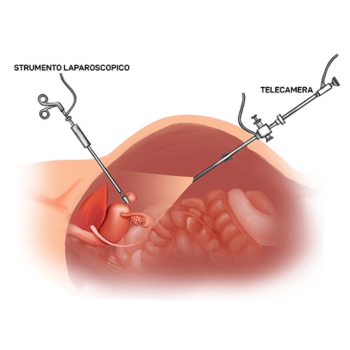 Calcolosi della colecisti