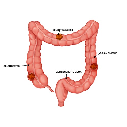 Calcolosi della colecisti