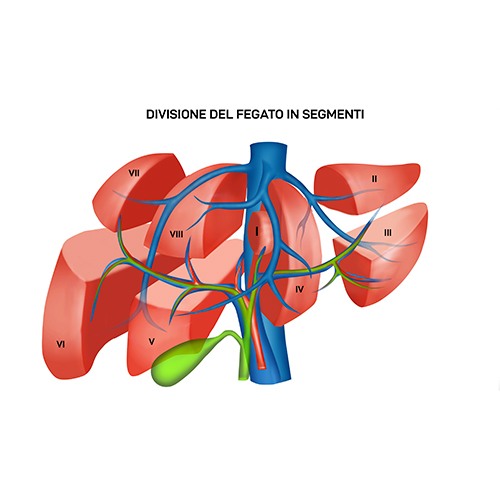 Calcolosi della colecisti