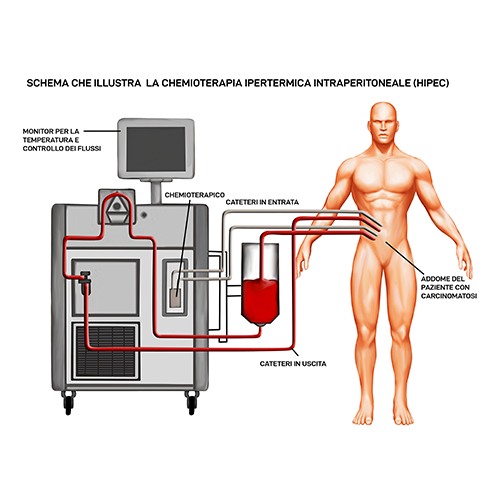 Calcolosi della colecisti