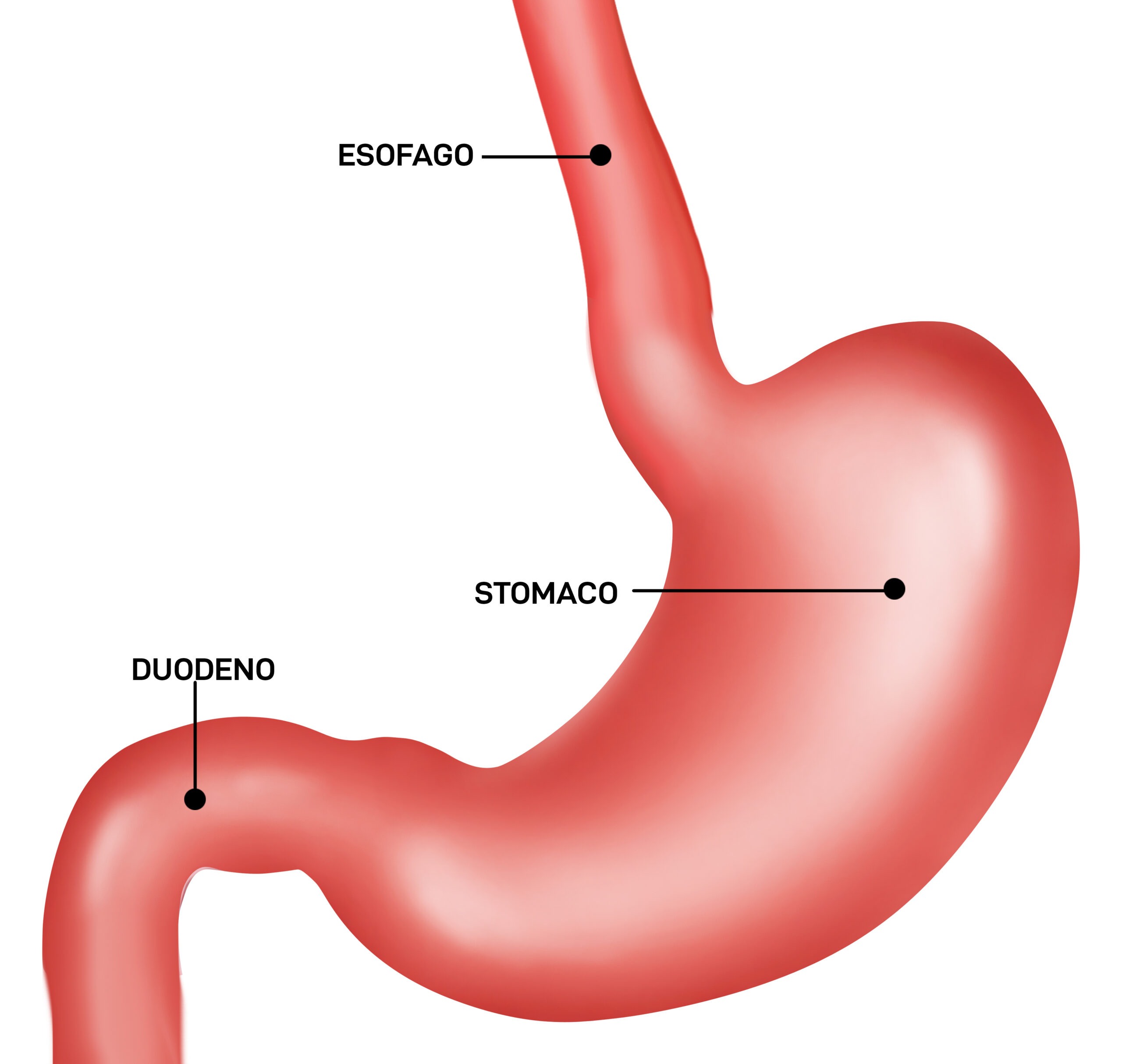 Calcolosi della colecisti
